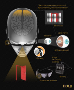 Infographic that explains bionic eye insertion into human