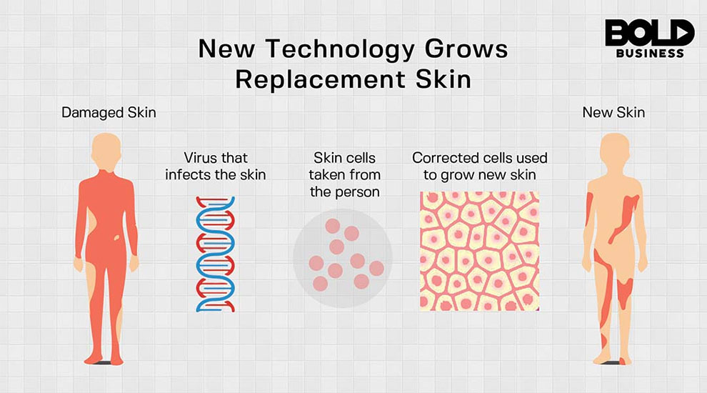 Stem Cell Genetics Saves A Dying Boy Gets Gene Corrected Skin