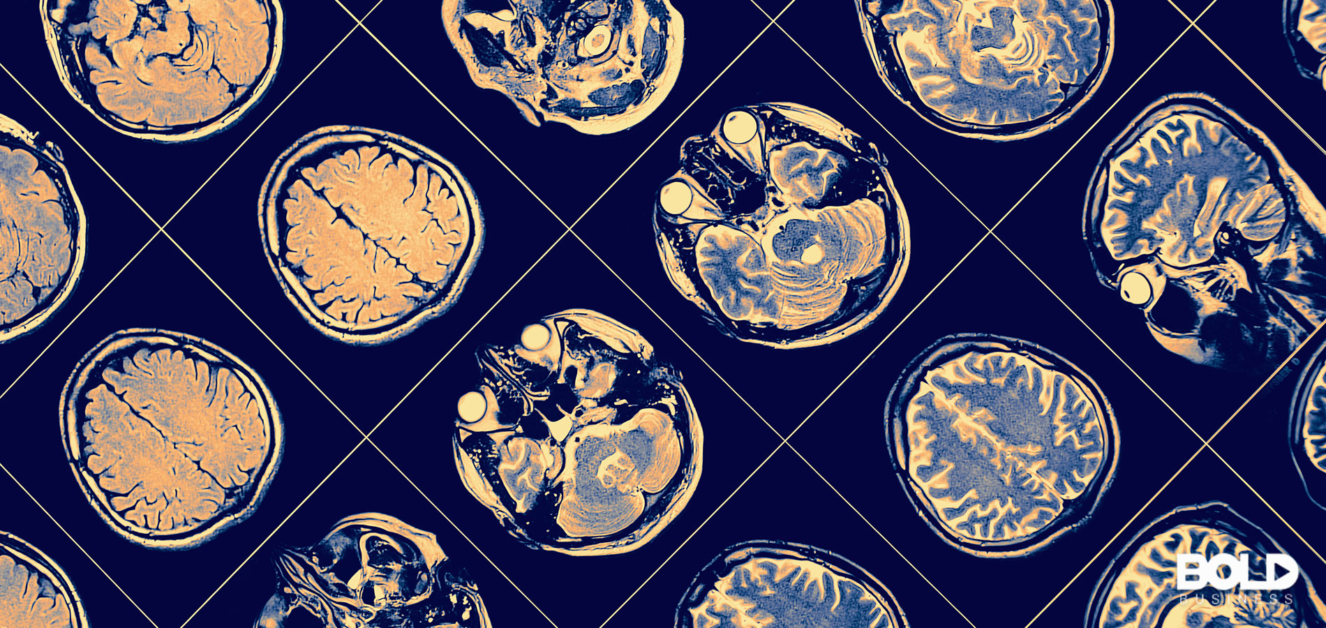 Diagnosing Early Brain Problems – The Future of Artificial Intelligence in Neurological Disease