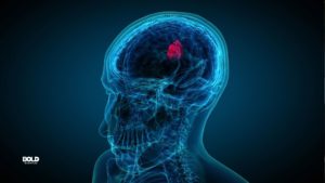Digital X-ray of a human head showing a highlighted area in the brain, symbolizing advancements in neurological research and brain health treatments.